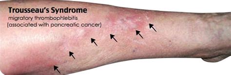 Thrombophlebitis (Superficial and Migratory): Symptoms, Causes .